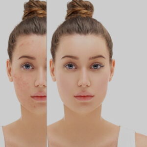 How to get rid of acne scars naturally and permanently