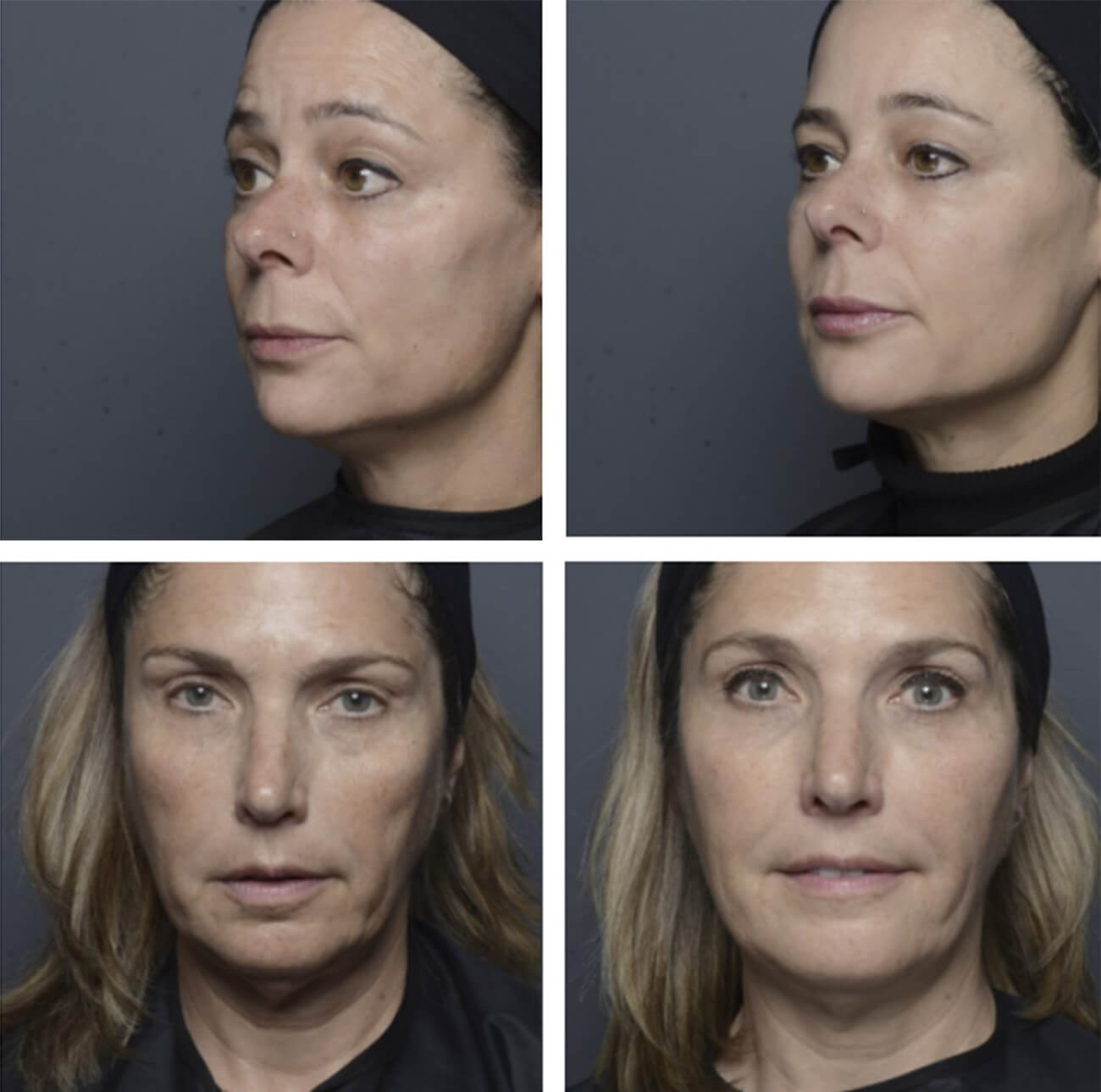 BOTOX and XEOMIN Treatment