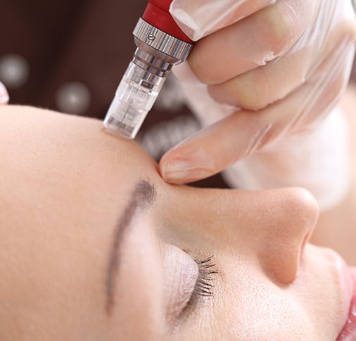 Traditional Microneedling versus RF Microneedling in Toronto