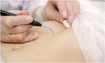 Electrosurgery in Toronto