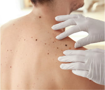 Laser Mole Removal in Toronto