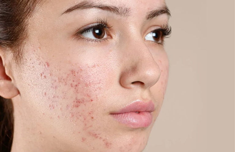 Acne Treatment in Etobicoke