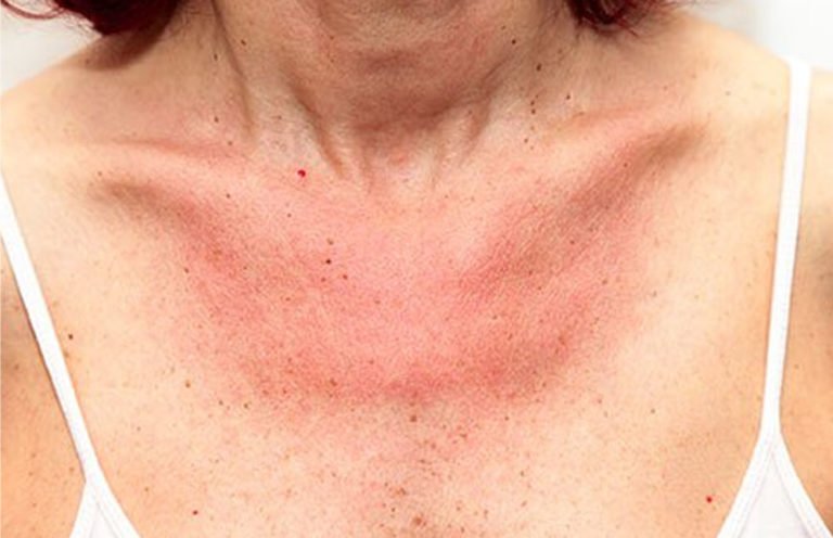 Actinic Keratosis Treatment in Toronto