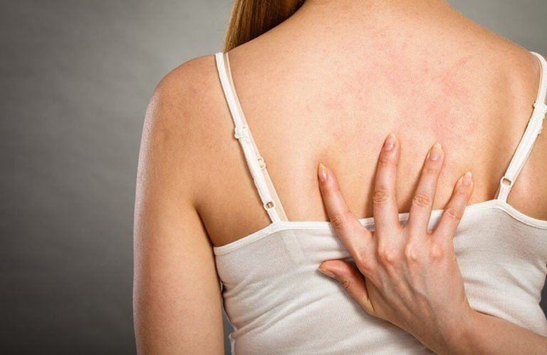 Eczema and Psoriasis Treatment in Etobicoke