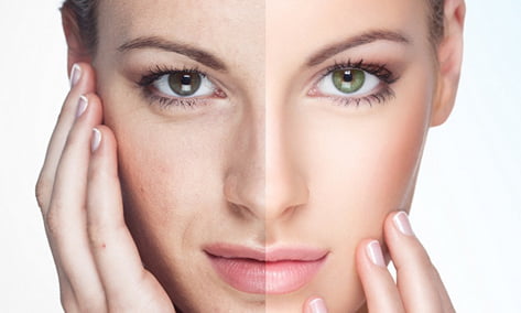 laser skin resurfacing in toronto