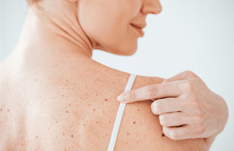 Mole and Skin Tag Removal in Toronto