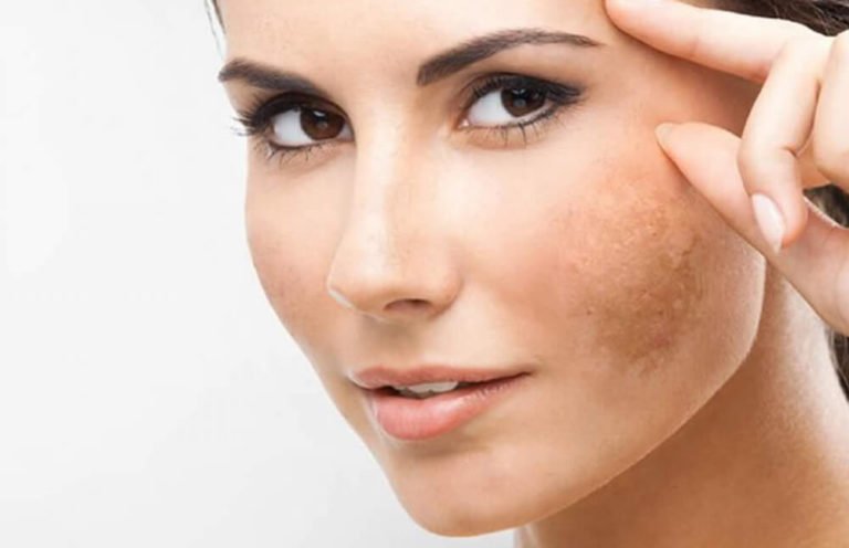 Pigmentation and Melasma Treatment in Etobicoke