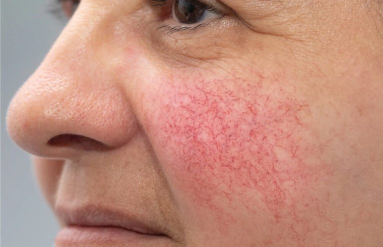 Rosacea Treatment in Toronto