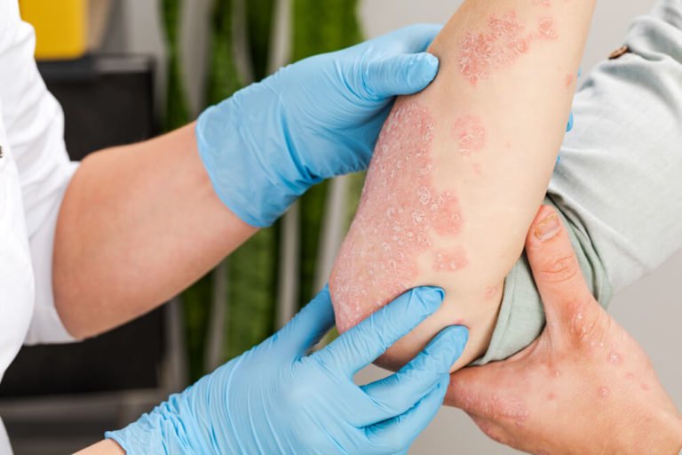 eczema and psoriasis treatment