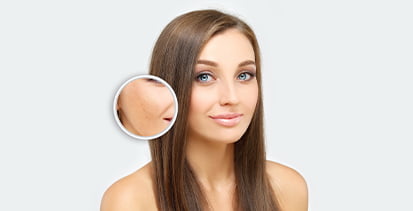 woman after melasma treatment toronto