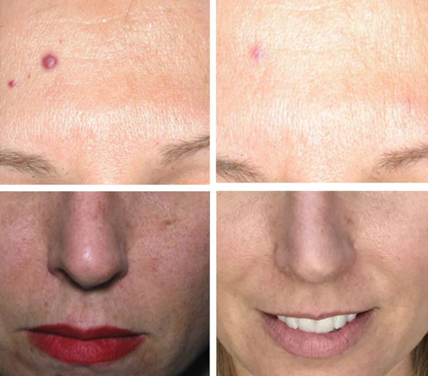 IPL Photofacial before and after results at Kingsway Dermatology in Etobicoke, Toronto