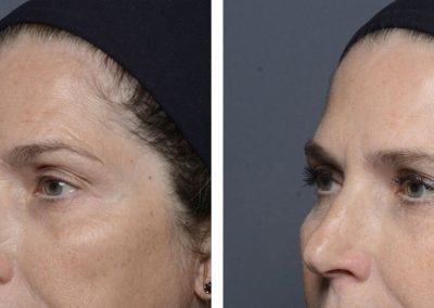 Botox treatment before and after at Kingsway Dermatology