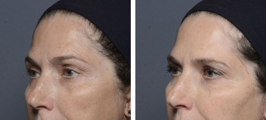 Botox treatment before and after at Kingsway Dermatology