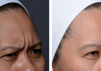 Botox forehead glabellar before and after at Kingsway Dermatology