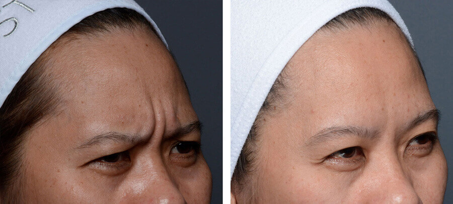 Botox forehead glabellar before and after at Kingsway Dermatology