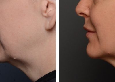 Ultherapy treatment before and after at Kingsway Dermatology