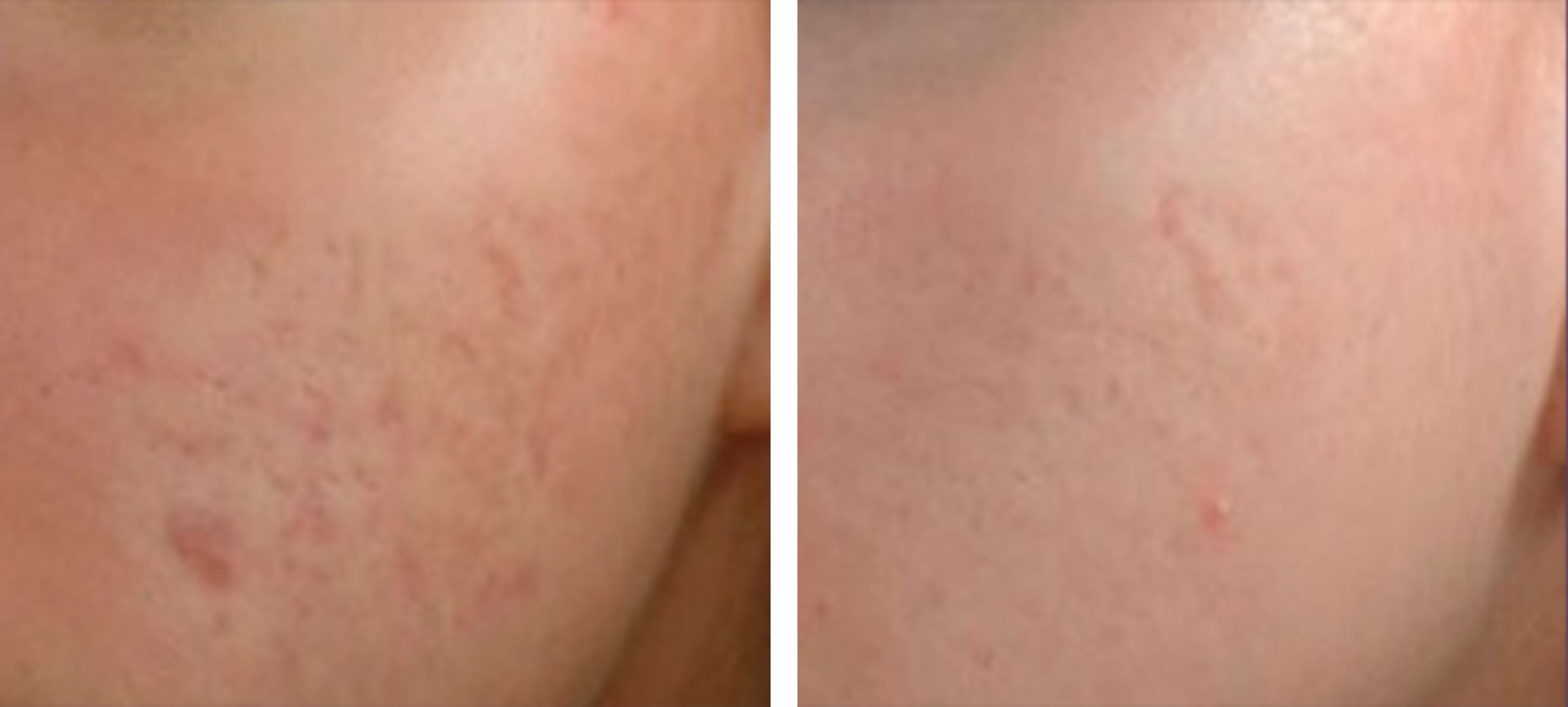 Acne & acne scars treatment before and after at Kingsway Dermatology
