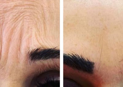 Botox forehead glabellar before and after at Kingsway Dermatology