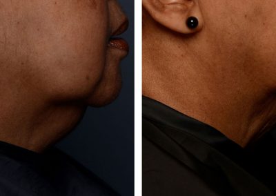 Before and After Belkyra Chin Reduction