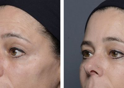 Botox treatment before and after at Kingsway Dermatology