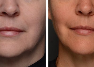 Ultherapy treatment before and after at Kingsway Dermatology