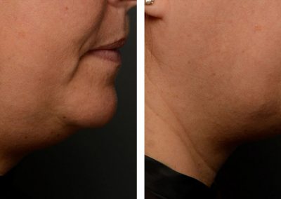 Before and After Belkyra Chin Reduction