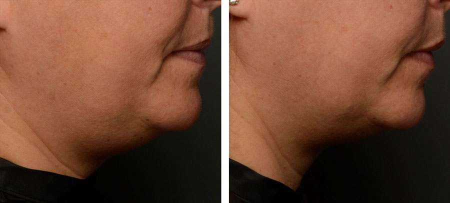 Before and After Belkyra Chin Reduction