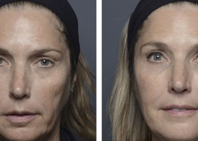 Botox treatment before and after at Kingsway Dermatology