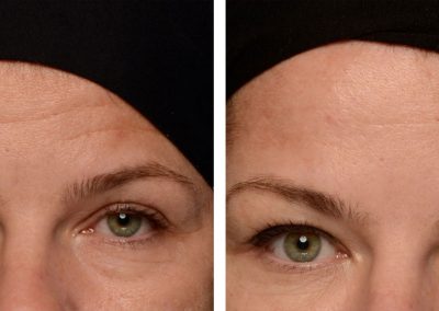 Botox forehead treatment before and after at Kingsway Dermatology