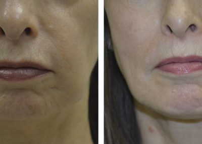 Ultherapy treatment before and after at Kingsway Dermatology