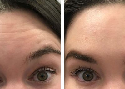 Botox forehead glabellar before and after at Kingsway Dermatology