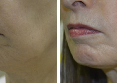 Ultherapy treatment before and after at Kingsway Dermatology