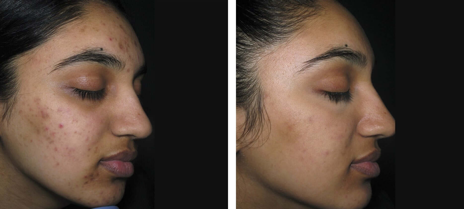 Acne & acne scars treatment before and after at Kingsway Dermatology