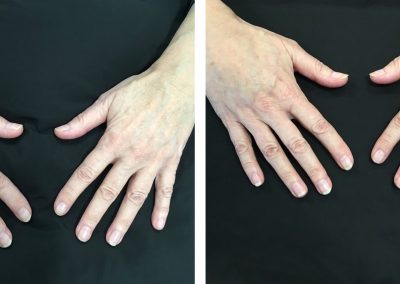 Hand rejuvenation before and after treatment at Kingsway Dermatology