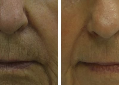 Lines and wrinkles treatment before and after