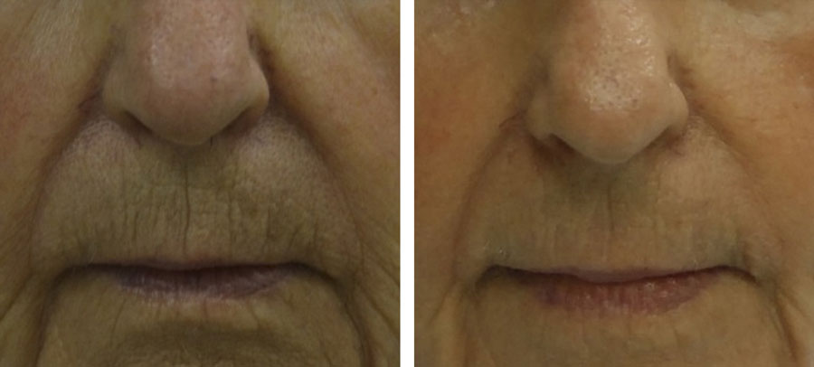 Lines and wrinkles treatment before and after