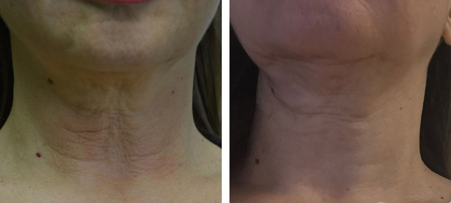 Before and After Platelet Rich Plasma Therapy