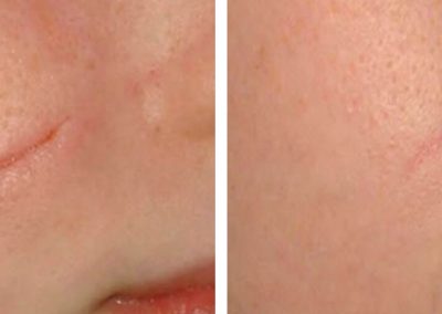 Scars before and after treatment at Kingsway Dermatology