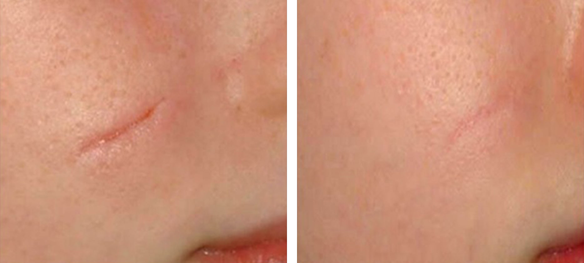 Scars before and after treatment at Kingsway Dermatology