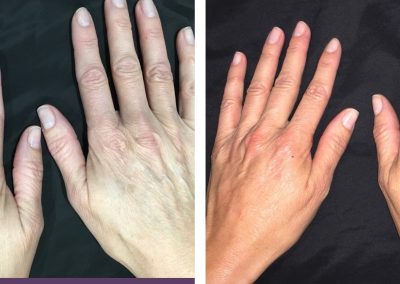 Hand rejuvenation before and after treatment at Kingsway Dermatology