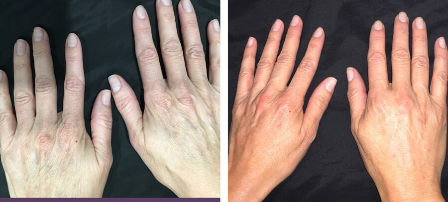 Hand rejuvenation before and after treatment at Kingsway Dermatology