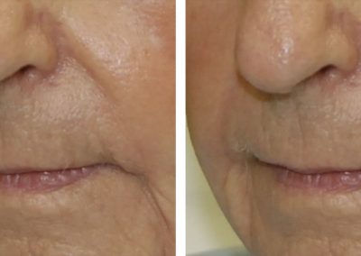 Lines and wrinkles treatment before and after