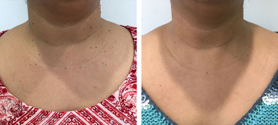 Moles and skin tags before and after treatment