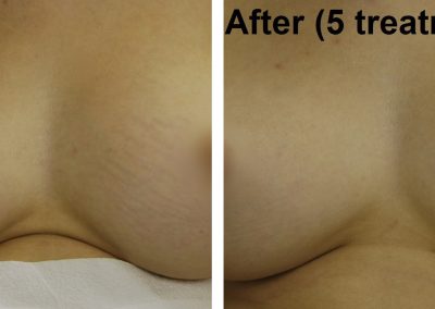 Scars before and after treatment at Kingsway Dermatology