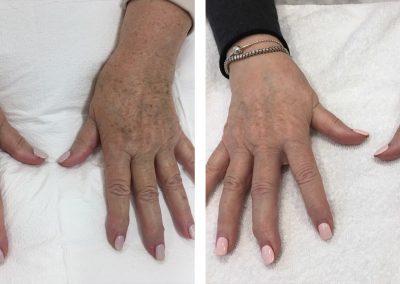 Hand rejuvenation before and after treatment at Kingsway Dermatology