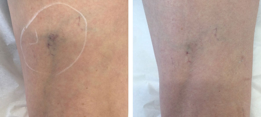 Before and After Spider Vein Treatment at Kingsway Dermatology