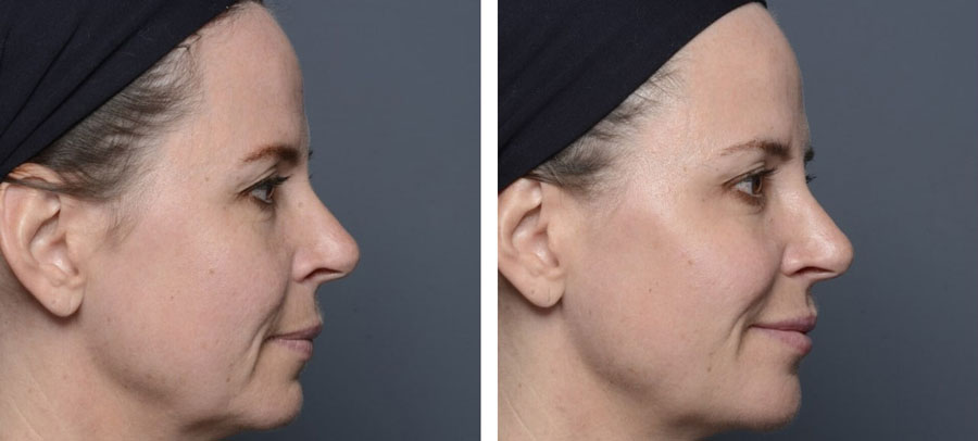 Before and After Volume Loss at Kingsway Dermatology
