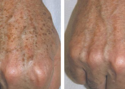 Hand rejuvenation before and after treatment at Kingsway Dermatology