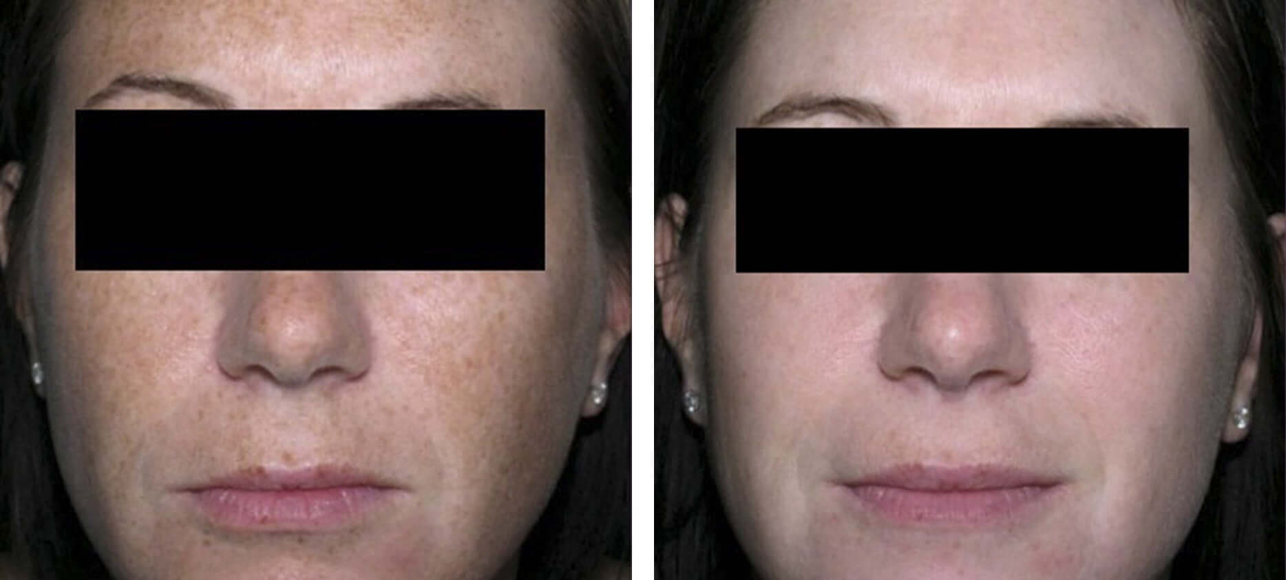 Brown Spots Before & After