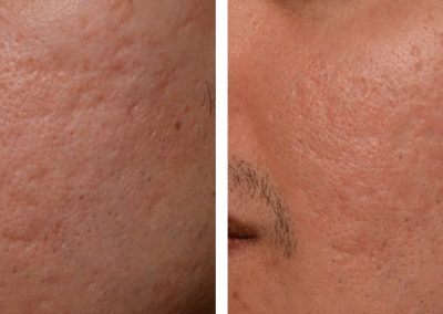 Laser cheek skin resurfacing treatment before and after at Kingsway Dermatology